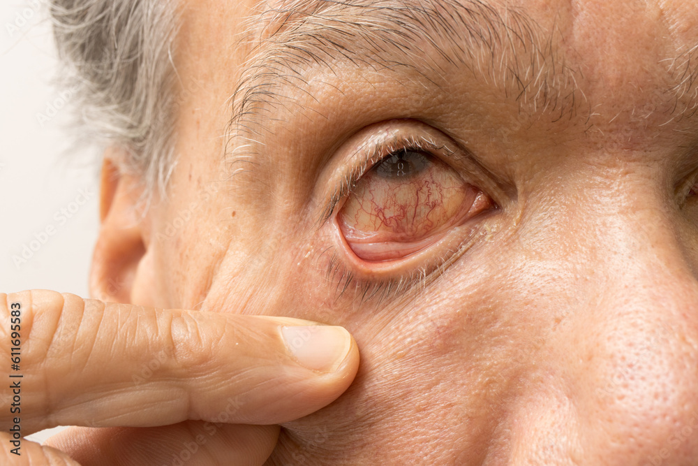 Senior Man with a pink eye infection in one of his eyes Senior Man with a pink eye infection in one of his eyes