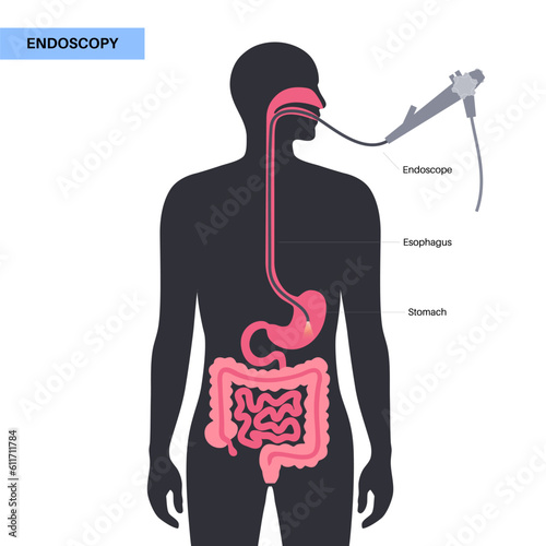 Gastroscopy endoscopy procedure