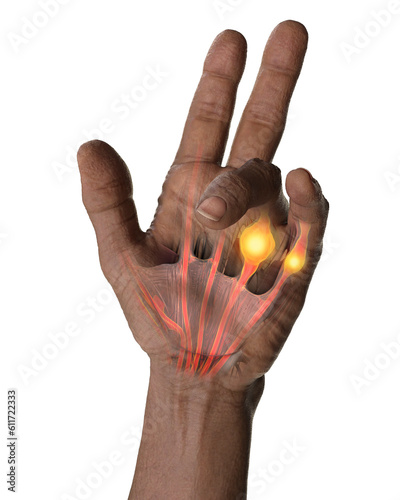 Фотография Hand of a male patient with Dupuytren's contracture, photorealistic 3D illustrat