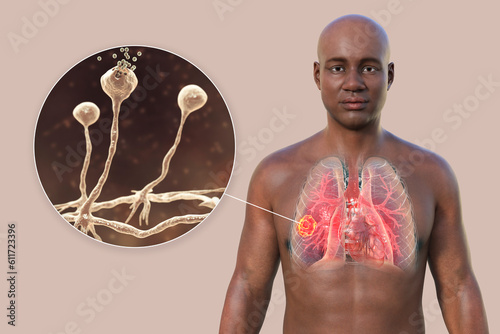 A 3D illustration of the upper half part of an African man with transparent skin, revealing a lung mucormycosis lesion, with close-up view of Rhizopus fungi photo