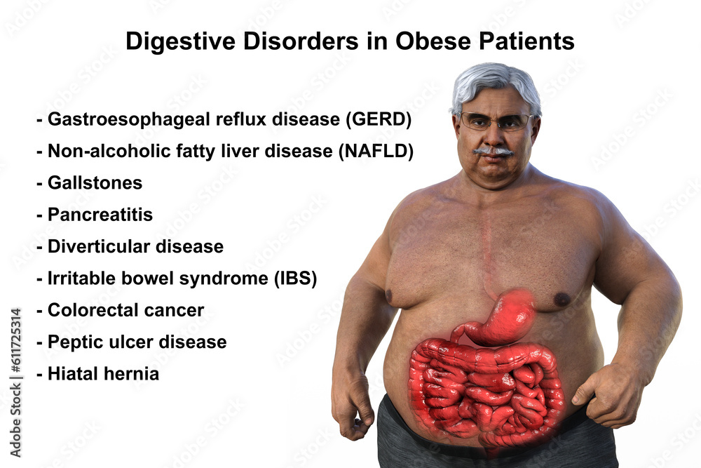 Digestive problems associated with obesity, 3D medical illustration of