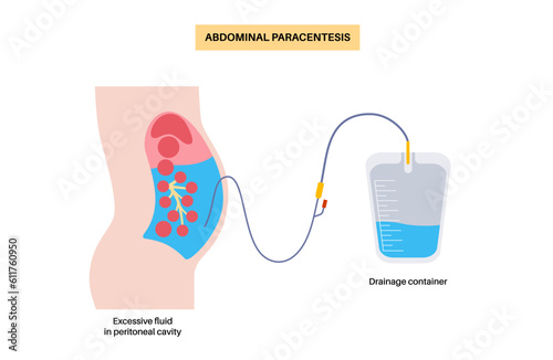 Abdominal paracentesis poster