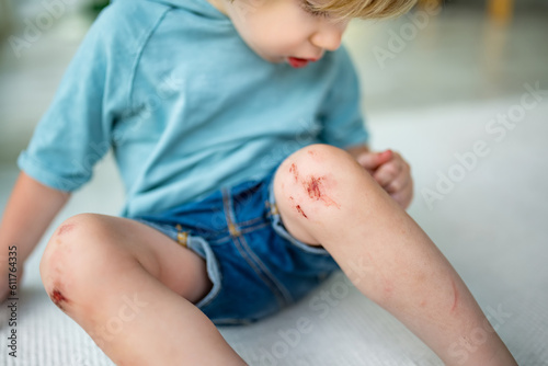 Toddler boy with scraped knees. Parent helping her child perform first aid knee injury after an accident.