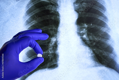 a hand in a blue medical glove holds a pill against the background of an X-ray of the lungs