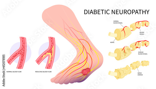 callus corn nerve clot damage feet limb pain injury of Charcot conduction velocity screening in leg bacteria sensory gout glucose plaque fat high sugar blister tingling test stroke diabetic