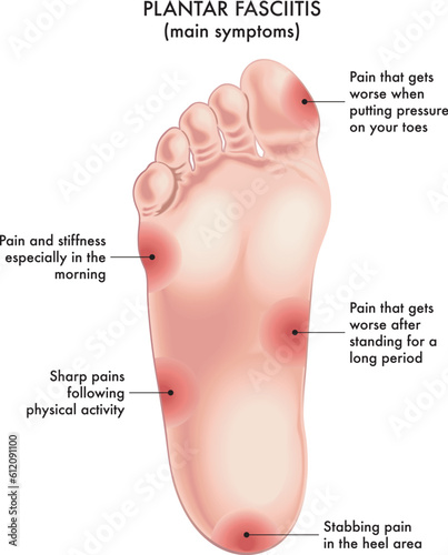 Medical illustration of the main symptoms of plantar fasciitis.