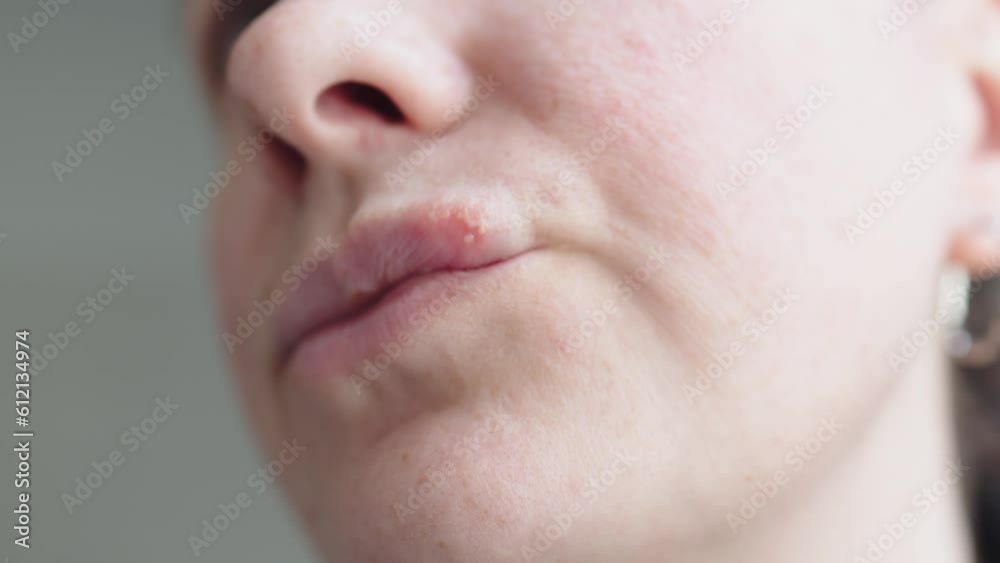 woman with sore on lips herpes simplex virus, vesicles on lip skin with