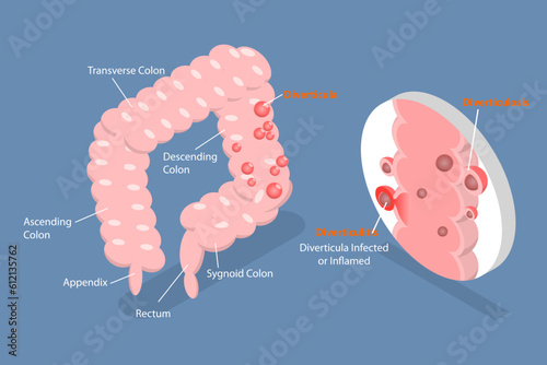 3D Isometric Flat Vector Conceptual Illustration of Diverticulitis, Medical Sructure and Location