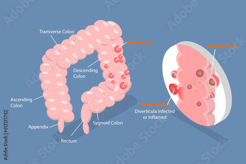 3D Isometric Flat Vector Conceptual Illustration of Diverticulitis, Medical Sructure and Location photo