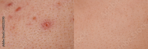Collage with photos of person suffering from acne before and after treatment, closeup. Banner design showing affected and healthy skin
