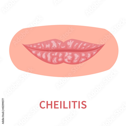 Cheilitis oral disease icon. Lips inflamation and irritation with cracking and peeling skin. Dermatitis outbreak. Medical concept. Vector illustration isolated on white.