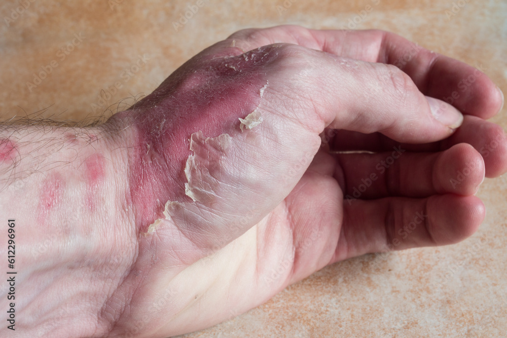 A close-up of a partially burned hand with a second-degree burn, revealing redness, cracking, and changing skin texture. First aid, wound healing, burn recovery. A close-up of a partially burned hand with a second-degree burn, revealing redness, cracking, and changing skin texture. First aid, wound healing, burn recovery.