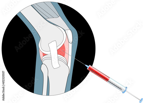 injection into the painful joint