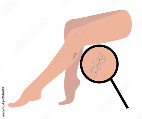 Varicoses. Female legs sitting with affected varicose veins. Blood pressure, pain and swelling. Disease of weak veins and valves. Vector illustration for medicine isolated on white background.