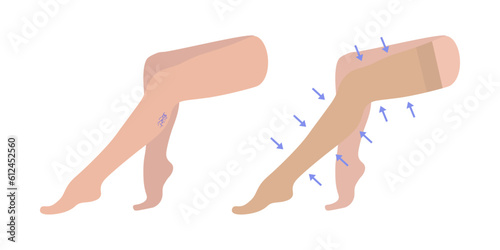 Varicoses. Female legs sitting with varicose veins. Blood pressure, pain and swelling.Women's compression stockings. Medical underwear for feet. Specialized hosiery for diseases. Vector illustration.