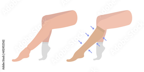 Edema. Female legs sitting with swollen foot and ankle. Lymphedema. Varicose veins. Women's Knee-high compression stockings. Medical underwear. Specialized hosiery for diseases. Vector illustration. photo