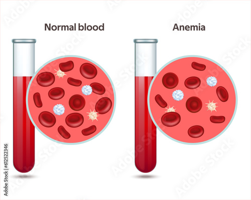 Two test tubes with normal blood and specimen with anemia disease. Thrombocytes, leukocytes and erythrocytes under microscope. Microbiology test. Vector illustration EPS 10