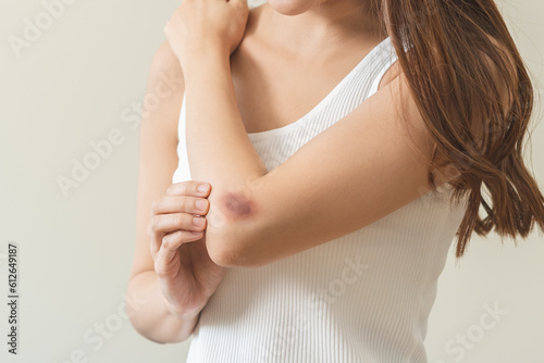 Close up of stain bruise wound on arm, contusion asian young woman, girl an accident fell down stairs, hand on elbow in healing injury by massage hematoma blood. Extravasation blue, purple on skin. photo