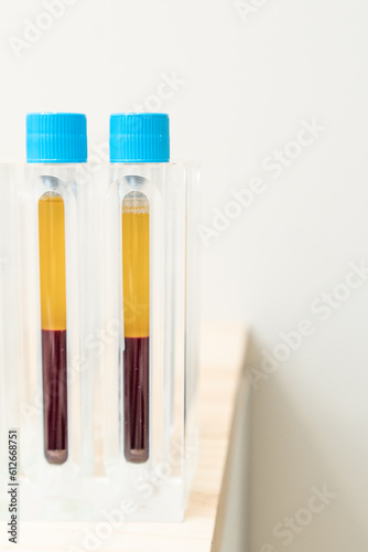 plasma specimens extracted from the machine photo