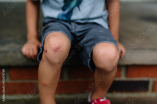 Closeup of child with skinned knee
