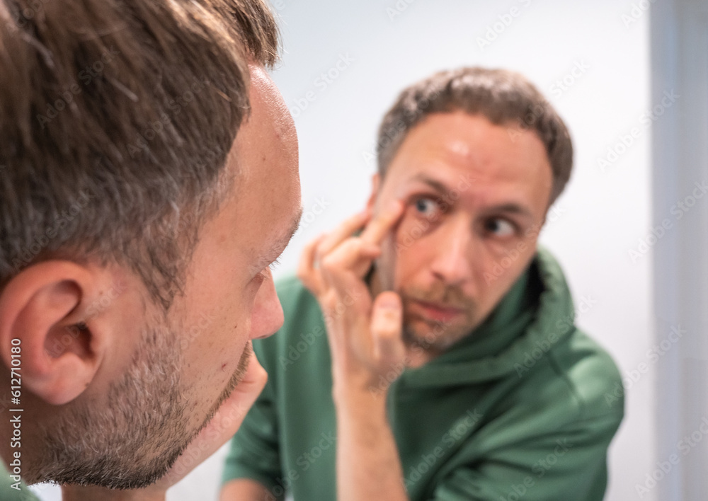 Fototapeta premium Young middle-aged man uses nourishing and regenerating cream for problem areas on his face. Skincare, wellbeing and healthy lifestyle concept.