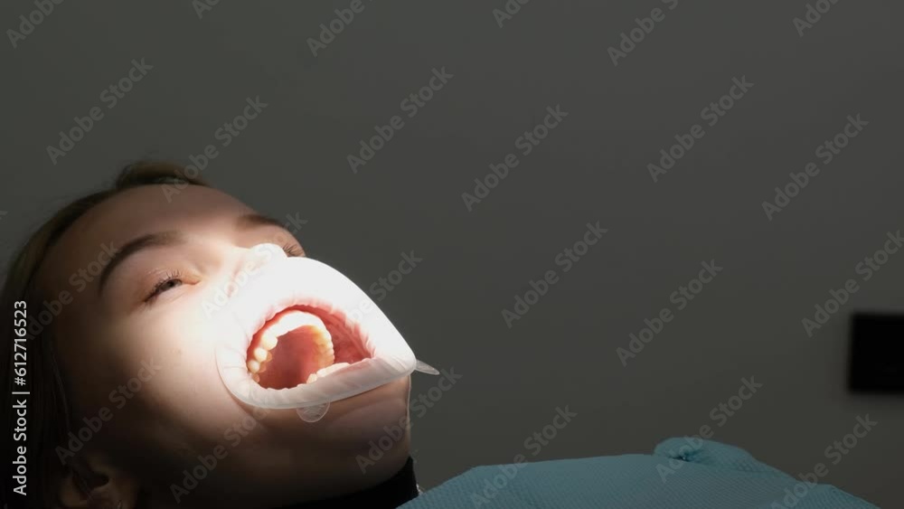 Female patient with open mouth during dental treatment. Capa during treatment.
