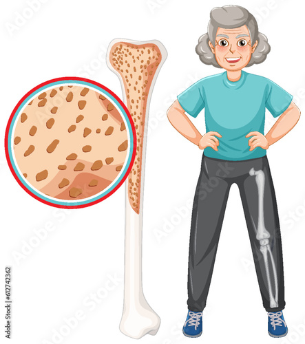 Osteoporosis in old people