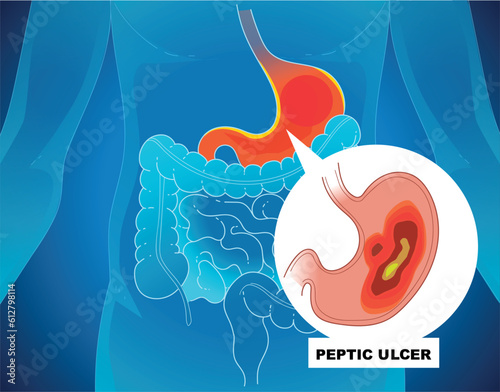 A human body with health problems. Inflammation on the stomach. Stomach (peptic) ulcer. Healthcare illustration. Medical illustration. Vector illustration.  photo