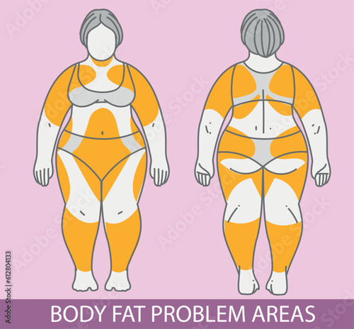 Body fat problem areas. Medical infographic. Healthcare illustration. Vector illustration. 