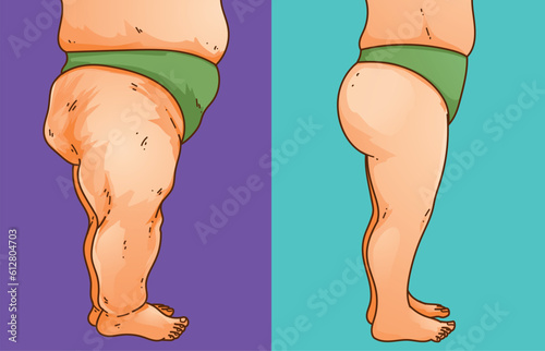 Lipedema. Women's legs with health problems. Before, after. Healthcare illustration, medical infographics. Vector illustration.
