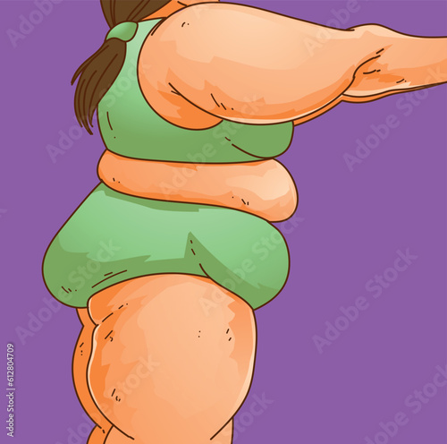 Lipedema. Women's body with health problems. Healthcare illustration, medical infographics. Vector illustration. photo