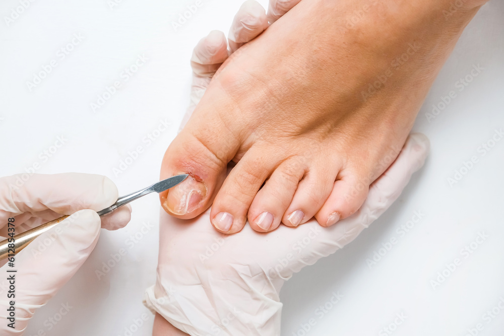 Pedicure, podologist. Patient on medical pedicure procedure, nail disease, cholesis detachment of the nail plate. Foot care, treatment in a medical spa salon. Pedicure, podologist. Patient on medical pedicure procedure, nail disease, cholesis detachment of the nail plate. Foot care, treatment in a medical spa salon.