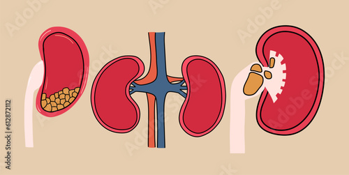 A set of kidneys with stones inside. Vector illustration in flat style