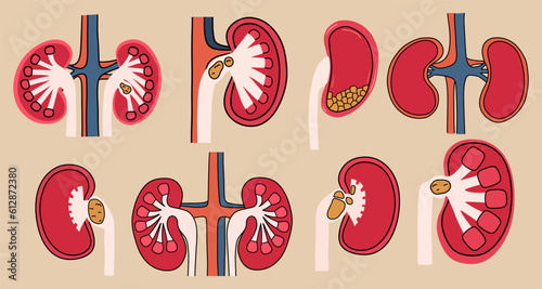 A set of kidneys with stones inside. Vector illustration in flat style