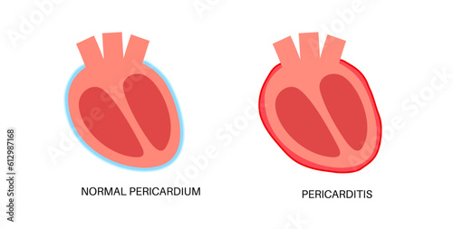 Pericarditis heart disease