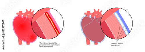 Pericarditis heart disease photo