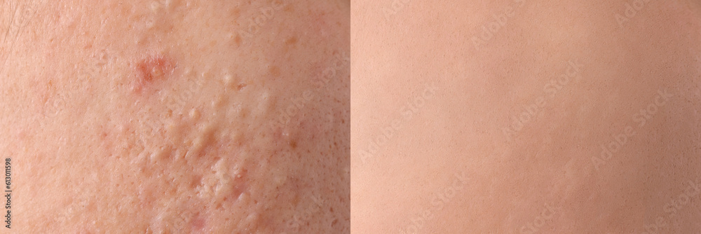 Fototapeta premium Collage with photos of person suffering from acne before and after treatment, closeup. Banner design showing affected and healthy skin