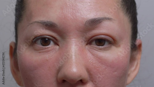 allergies, rosacea, rosacea, redness of the skin, red spots on the cheeks, a woman with sensitive skin, a close-up of the patient's face