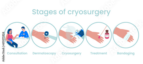 Stages of the cryosurgery procedure in the treatment of skin neoplasms. Consultation, dermatoscopy, treatment, dressing. Flat vector illustration.