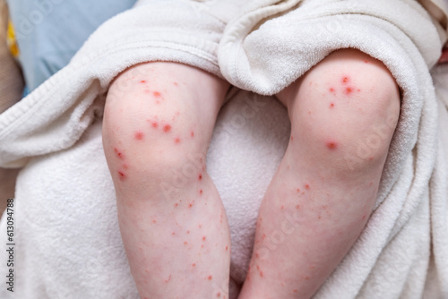 Skin rash on the legs of a small child. Ulcers from scratching. Acute viral disease of coxsackie. Allergic reaction.