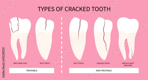 Fracture and grinding pain toothache syndrome teeth crack broken Bad breath in dentistry