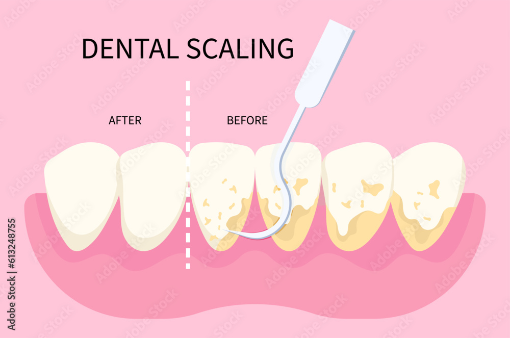 Dental scaling for toothache in dentistry with abfraction disease of