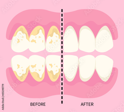 Before and after of dental scaling for toothache in dentistry with abfraction disease the teeth fracture crack broken with Bad breath grinding pain syndrome