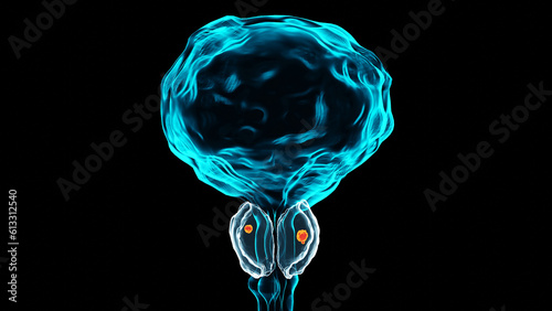 Prostate cancer stages. ancerous cells, malignant tumor compresses urethra. Pathological disruption, genital reproductive system anatomy, bladder Oncological or Urological Disease, bph, 3d render