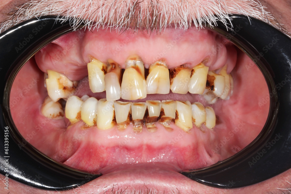 Chronic generalized Paradontitis. Severe Periodontal disease or