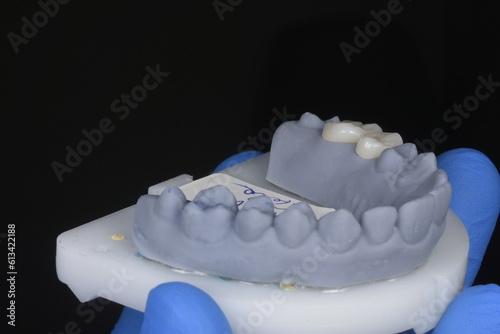 Brilliant Zirconium Duo: A Striking Model Showcasing Twin Dental Gems