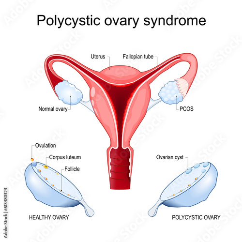Polycystic ovary syndrome