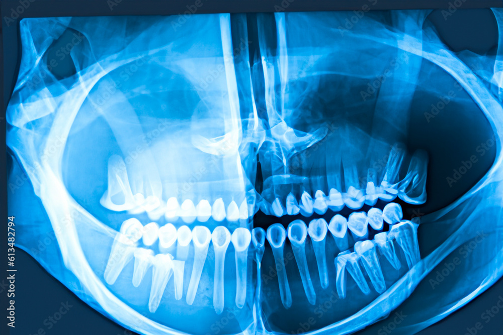 Xray. Xray of head, foot, head, mouth, ribs and hands. Bone scan. Body injury. Xray analysis