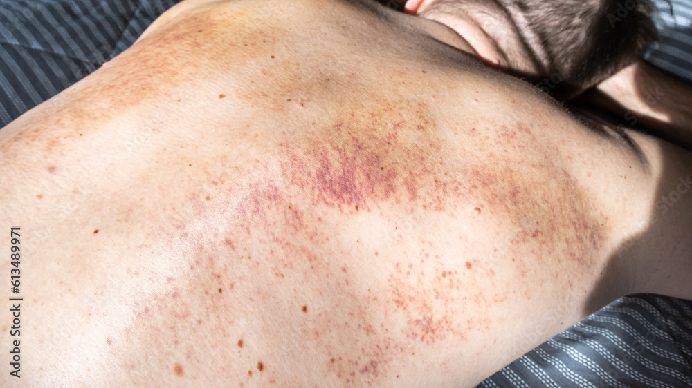 Naklejka premium Close up bruises on the back of a man after a massage, treatment of seals and bruises after massage