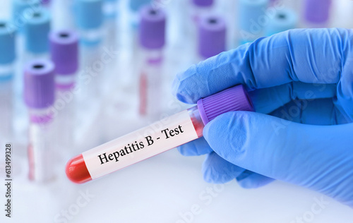 The doctor holds a test blood sample tube with hepatitis B virus  HBV  test on the background of medical test tubes